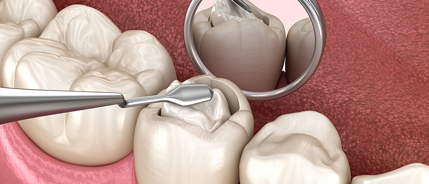 The Evolution of Tooth Decay Over the Ages