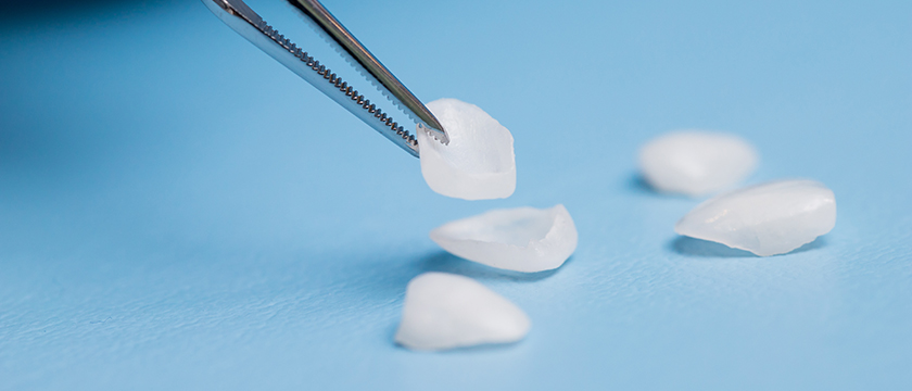 What Are Veneers? Understanding the Benefits, Costs, and Alternatives