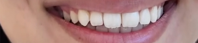 Before image of a close-up smile with misaligned teeth, used to show invisalign mississauga treatment starting point.